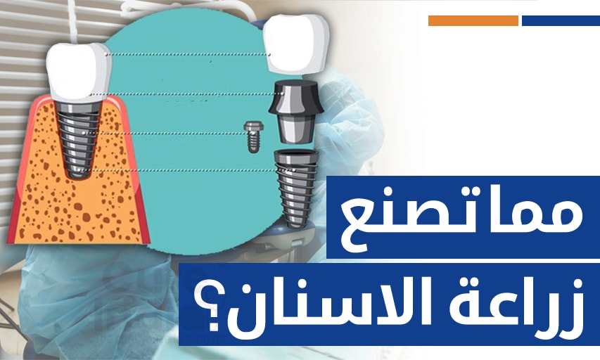 مما تصنع زراعة الاسنان؟